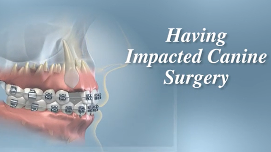 having impacted canine surgery