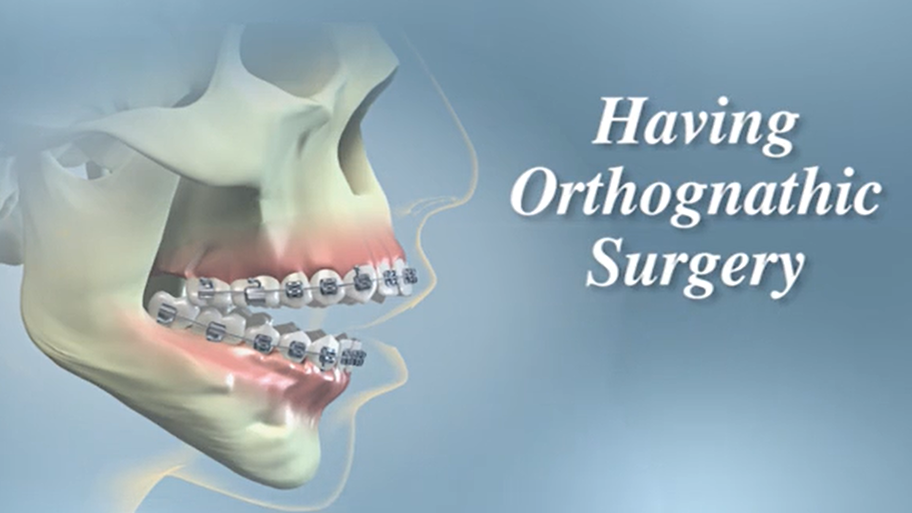 having orthognathic surgery