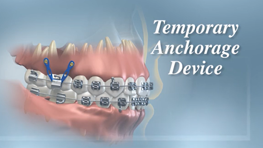 Temporary Anchorage Device